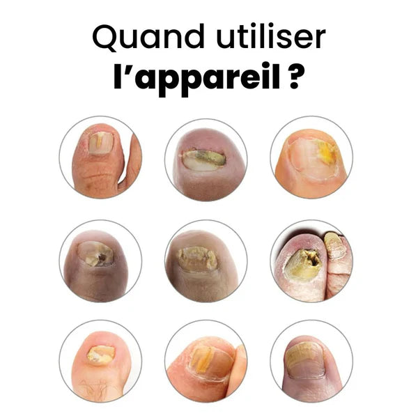 Appareil laser de classe I à usage domestique pour le traitement des mycoses des ongles des mains et des pieds et l'élimination de l'onychomycose