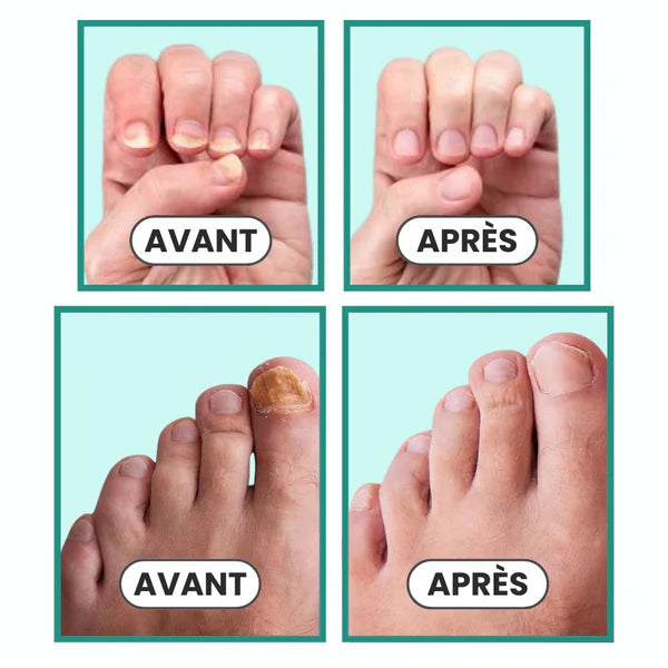 Appareil laser de classe I à usage domestique pour le traitement des mycoses des ongles des mains et des pieds et l'élimination de l'onychomycose